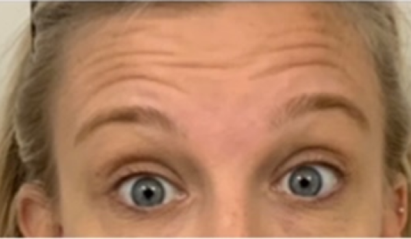 Before-Forehead Result