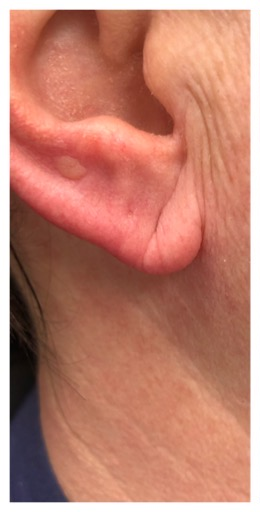Before-Ears Result
