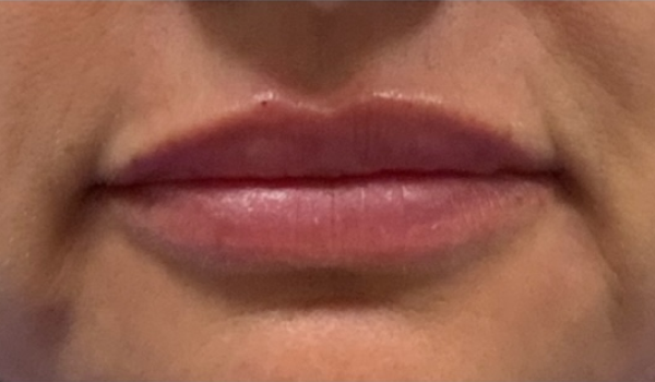 After-Lips Results