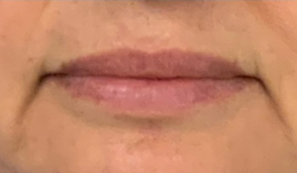 Before-Lips Results