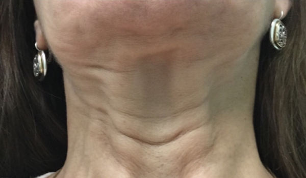 Before-Neck Result